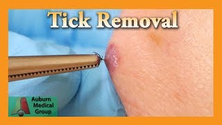 Dead Tick Removal  Auburn Medical Group [upl. by Monarski422]