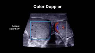 Diagnosing testicular torsion [upl. by Valentin]