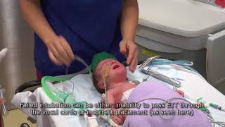 Paediatric Anaesthetics Chapter 3  Failed intubation neonate [upl. by Latashia]