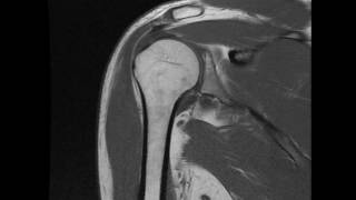 Partial thickness supraspinatus tear  cor T1 [upl. by Ainitsirk]