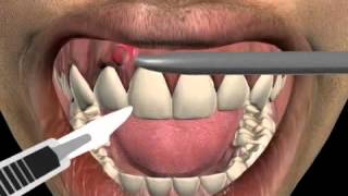 How to treat a tooth abscess [upl. by Gregoire]