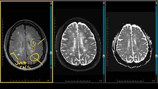 Demyelination Case Review  ADC Negative Multiple Sclerosis [upl. by Samled]