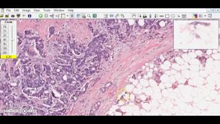 Breast ductal carcinoma Breast cancer [upl. by Breger523]