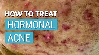 How to Treat Your Hormonal Acne  A Skincare Experts Advice [upl. by Yrrak]