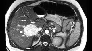 Liver Hemangioma [upl. by Steere]