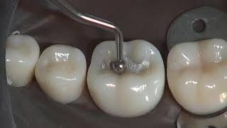 Class I Amalgam Preparation amp Restoration  Operative Dentistry [upl. by Parrie]