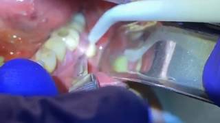 Draining a Dental Abscess  Advanced Dental Care [upl. by Frederik]