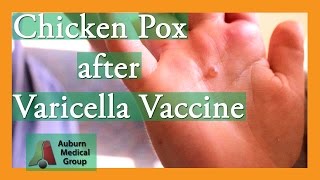 Chicken Pox after Varicella Vaccine  Auburn Medical Group [upl. by Charo]