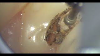 Caries Removal and indirect pulp capping [upl. by Alvita123]