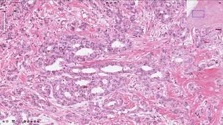 Ductal Carcinoma  Breast [upl. by Dent]