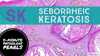 Seborrheic Keratosis 5Minute Pathology Pearls [upl. by Jones]