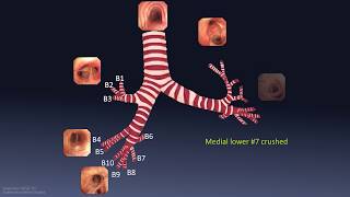 Mastering Bronchoscopy for Thoracic Surgery Chapter 1 [upl. by Hoehne401]