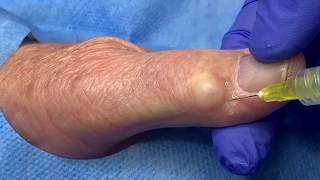 Ganglion Cyst Jelly Doughnut Hole Extraction [upl. by Evatsug474]