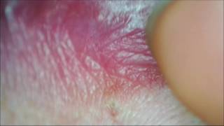 Espinilla gigante en el labio Lip blackhead [upl. by Erodavlas469]