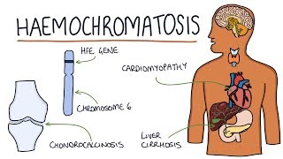 Understanding Haemochromatosis [upl. by Loftis]