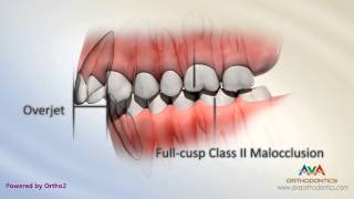 Malocclusion  Class II Div I [upl. by Ttevy968]