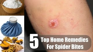 5 Home Remedies for Spider Bites  By Top 5 [upl. by Amethist646]