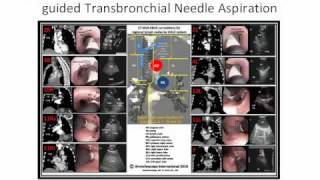 EBUSCTBronchoscopy Poster [upl. by Michigan289]