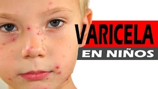 Varicela en niños  Tratamiento natural y casero [upl. by Tcideneb]