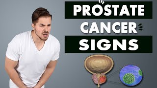 5 signs in prostate cancer amp physician’s view on its test methods [upl. by Eybba]