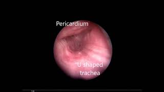 Pericardial Patch Tracheoplasty for Relapsing Polychondritis [upl. by Argyle993]