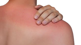 How To Treat and Prevent Heat Rash  Rachaels Dermatologist Dr Anne Chapas [upl. by Sakmar318]