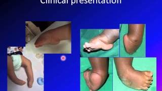 clubfoot  talipes equinovarus  TEV [upl. by Eedna]