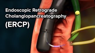 ERCP vs MRCP T tube cholangiogram PTC [upl. by Llehsem]