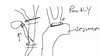 Common bile duct exploration Never laparoscopically [upl. by Hairacaz730]