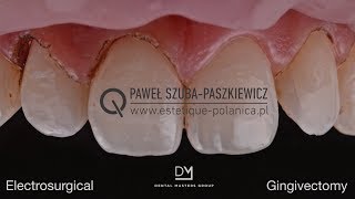 Electrosurgical Gingivectomy  Crown Lengthening [upl. by Aronaele]