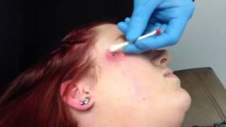 Dermal Piercing on cheek [upl. by Low]