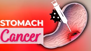 Stomach Cancer Causes Signs and Symptoms Diagnosis and Treatment [upl. by Ambrogio749]