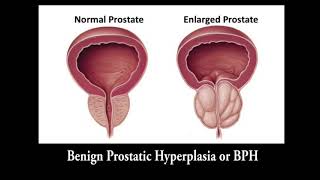 Dr Jared Moss Greenlight Laser for BPH [upl. by Lasiaf532]