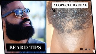 Alopecia Barbae  Beard Symptoms Causes Treatments  Beard Patches [upl. by Thordis]