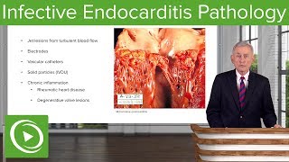 Infective Endocarditis IE Pathology – Infectious Diseases  Lecturio [upl. by Terrye]