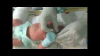 Neonatal Digital Intubation Part 1 [upl. by Aittam]