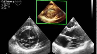 Mitral annular disjunctionMAD  mitral valve prolapse Barlows disease ampmitral incompetence [upl. by Ellard]