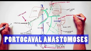 Meckel’s Diverticulum [upl. by Buddy]