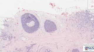 Breast Invasive ductal carcinoma vs DCIS [upl. by Heymann]