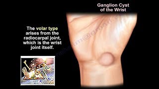 Ganglion Cyst Wrist  Everything You Need To Know  Dr Nabil Ebraheim [upl. by Colfin156]