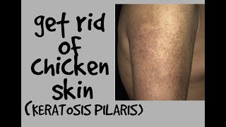 HOW TO GET RID OF CHICKEN SKIN KERATOSIS PILARIS DR DRAY [upl. by Hallam112]