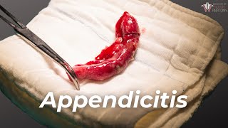 Examination of signs of Appendicitis [upl. by Shira]