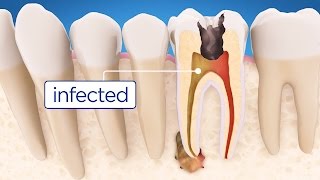 Root Canal Treatment Step by Step [upl. by Aihsot]