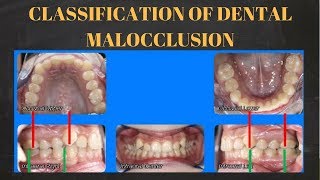 Trailer  Classification of dental malocclusion [upl. by Venable]