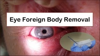 Eye Foreign Body Removal [upl. by Baal]