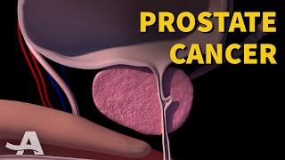 5 Early Signs of Prostate Cancer [upl. by Emearg]