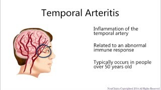 Temporal arteritis [upl. by Rossuck87]