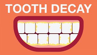 What causes tooth decay [upl. by Teik]