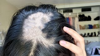 Im going bald  Alopecia Areata What I did to grow my hair [upl. by Hambley]