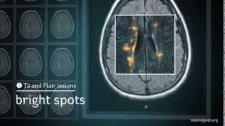 Multiple Sclerosis Understanding Your MRI [upl. by Aicak]